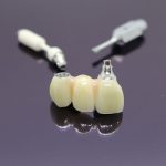 Implant Bridge Anterior IMG 1212