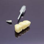 Implant Bridge Posterior IMG 1146