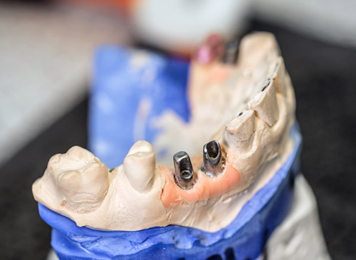 dental implants service 1